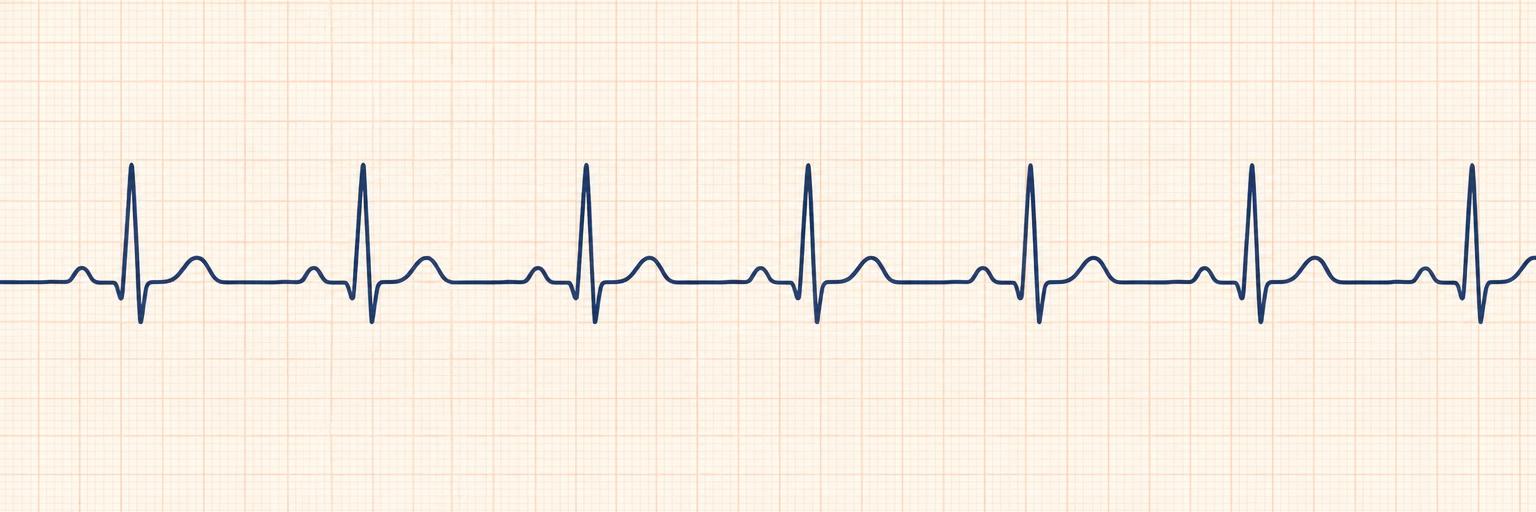 ECG rhythm strip